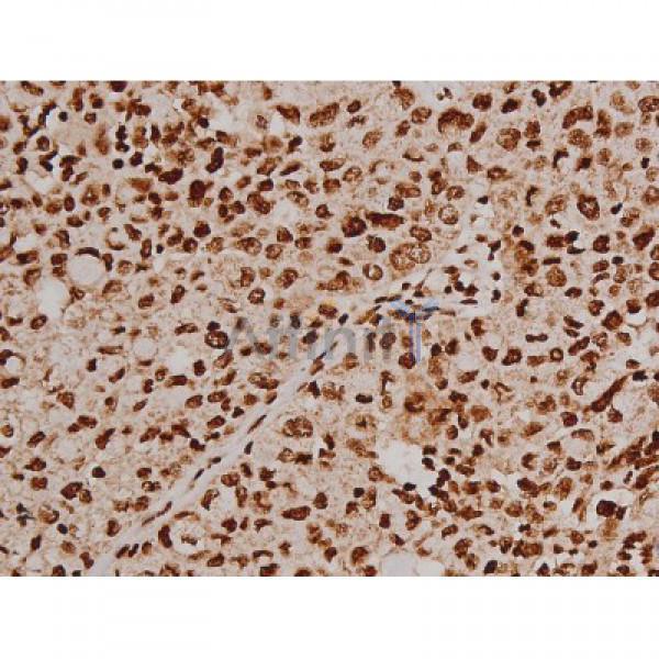 Phospho-FAK (Tyr397) Antibody - AF3398 at 1/200 staining Human lung cancer tissue sections by IHC-P.